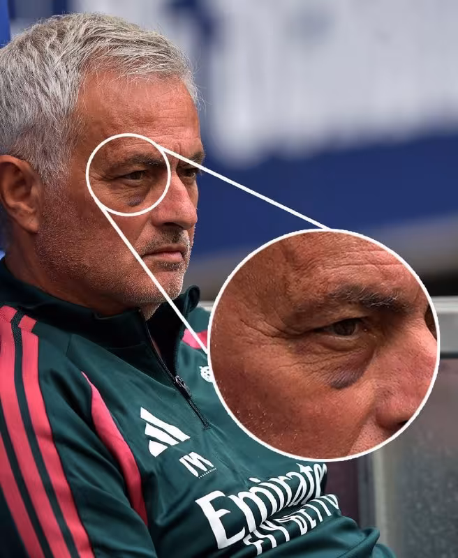 Joze Mourinyoning ko'zi nima sababdan ko'kargani ma'lum bo'ldi